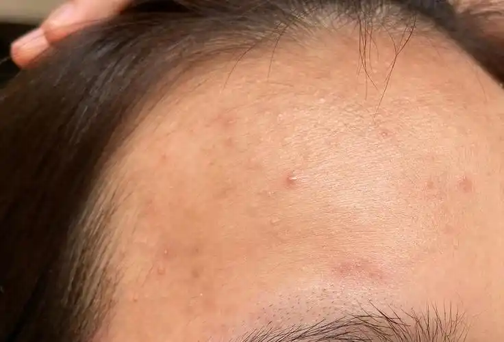 突然爆起满额头痘痘和包姐妹们救救我0606