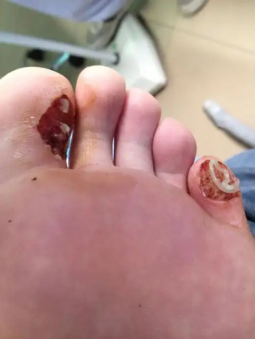 病毒性跖疣图片_有来医生