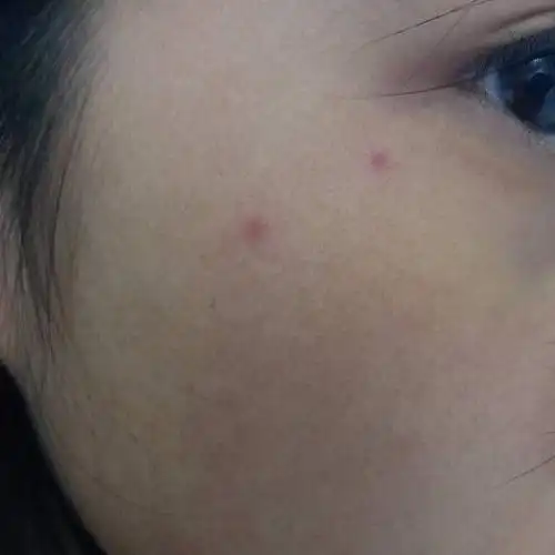 脸上长了红点不疼不痒,过几天就消掉了 是怎么回事