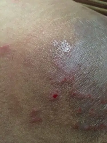 老公大腿内侧长得这种皮癣,之前没注意,问他说长了好久了,偶尔很痒