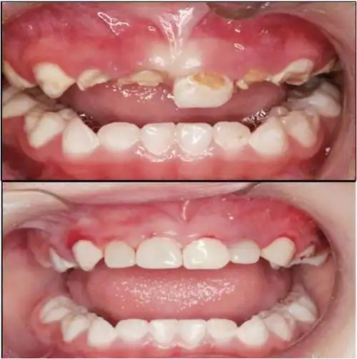 儿童乳牙预成冠该如何操作?图文视频全解!