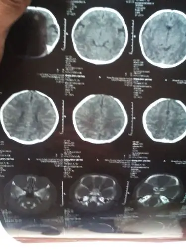 宝宝出生第二天开始抽搐然后拍ct发现颅内出血,请帮忙看下严不严重,有