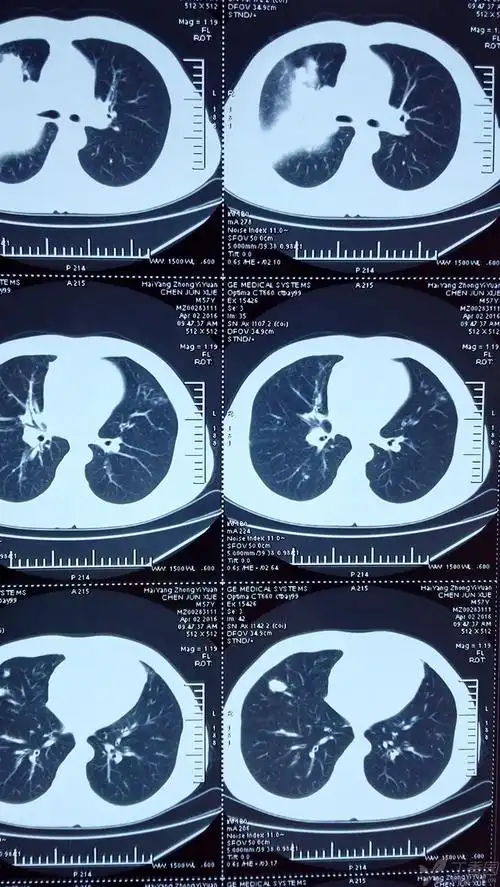 血气正常.胸部ct:右肺上叶大叶性肺炎. 临床诊断:肺炎,大叶性.
