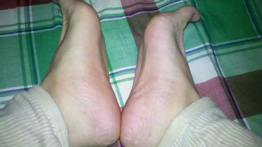 我这是扁平足吗?