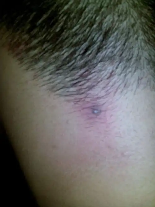 脖子上长个小痘痘上面是黑色的