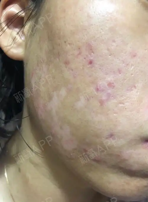 光子嫩肤术后第六天,脸上的黑色结痂已经全部掉啦,新_圈子-新氧美容