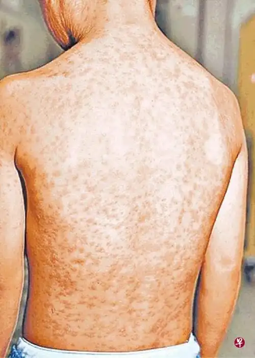 社论:富裕国家麻疹复燃说明什么