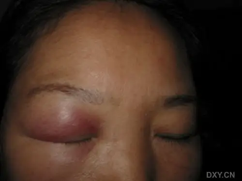 【病例讨论】肿胀性红斑狼疮1例 [病例帖]