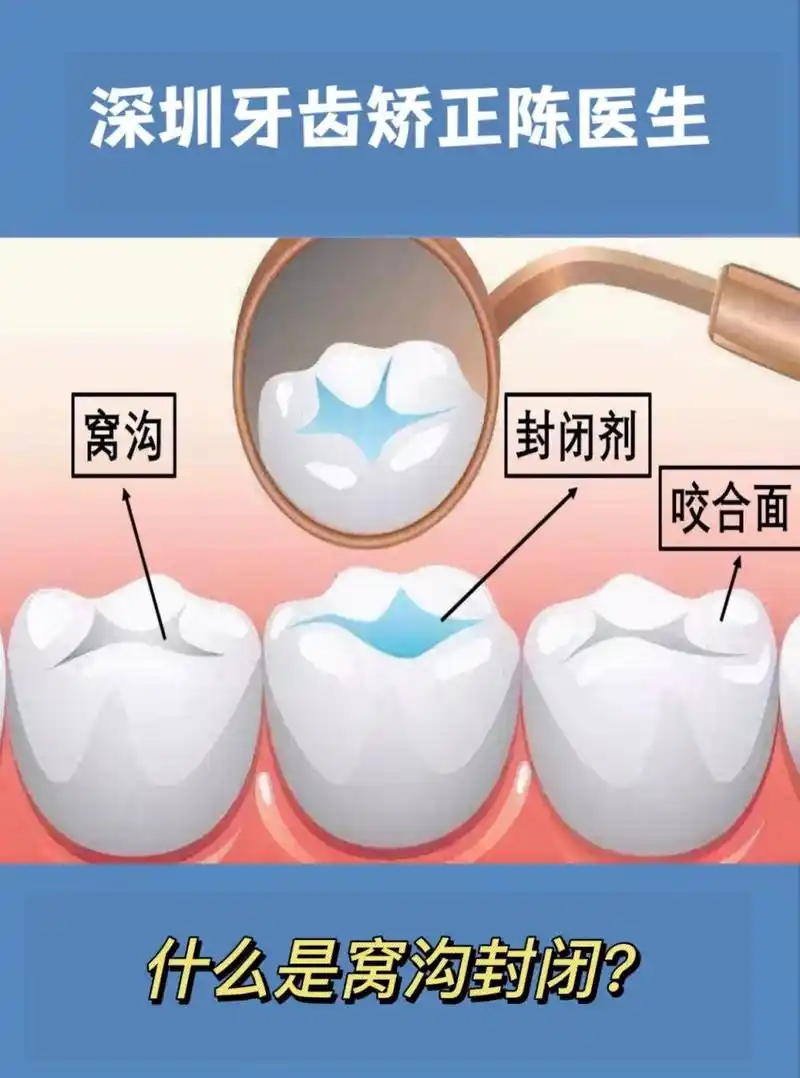 什么是窝沟封闭71 ·窝沟封闭是指在不损伤牙齿的情况下,将窝沟封闭