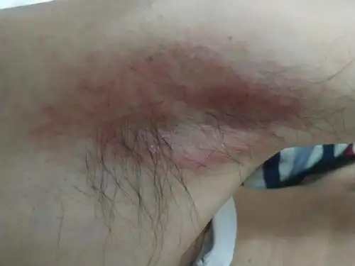 不知道是不是太热了的原因夏天腋下红了一大片要擦掉什么药比较好