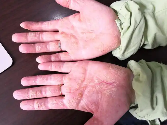 湿疹是怎么引起的?中医如何解释治疗?