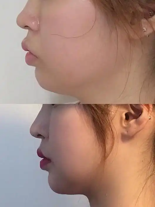 脸圆可能不是因为胖,而是没下巴-我的下巴短了一些,_圈子-新氧美容