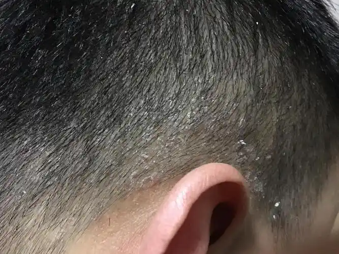 头发头皮屑比较多有没有人知道这个是什么情况