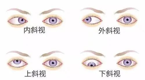 斜视视觉训练概述