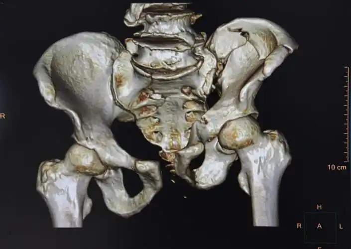 重物砸成严重粉碎性骨折,骨盆植入3块钢板活动自如