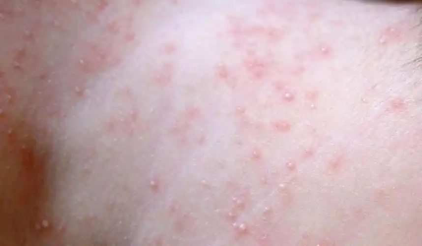 宝宝长痱子如何处理?