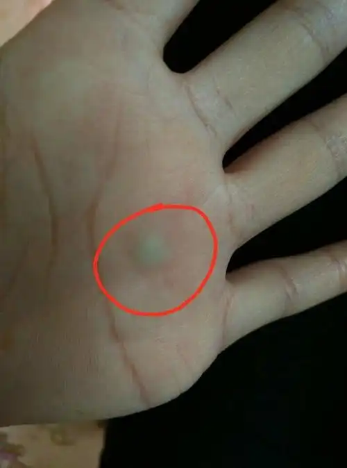 手掌心长了个白色的东西和一个球差不多还会动没有过往病史