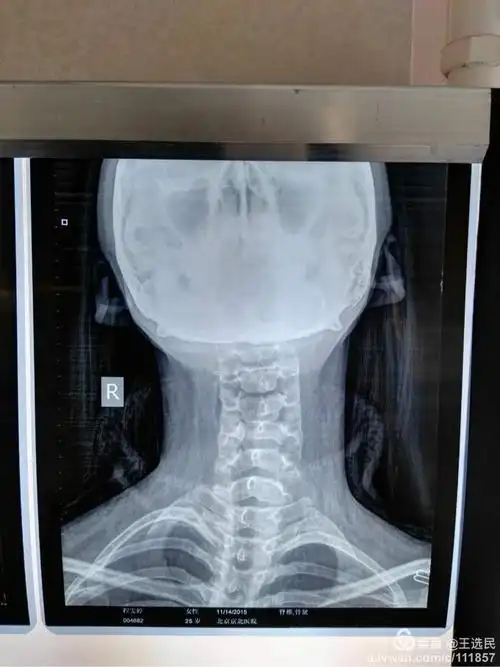 颈椎多发小关节错位,建议摄张口位片子(观察寰枢椎)