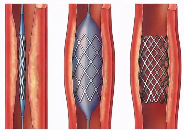 "颈动脉"被堵塞导致偏瘫,安"支架"还有意义吗?