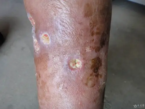 请问有谁看过这种皮肤病有点恶心