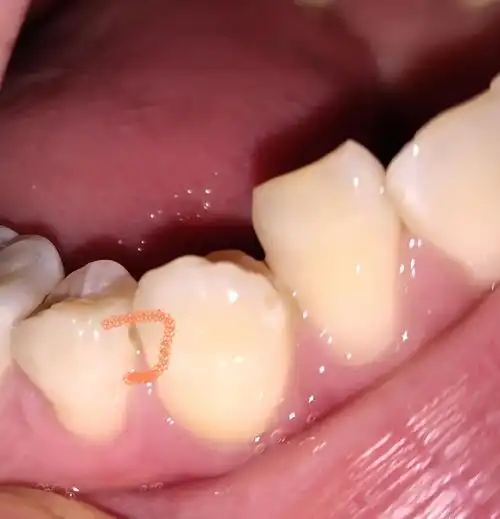 牙齿上面有个凹陷