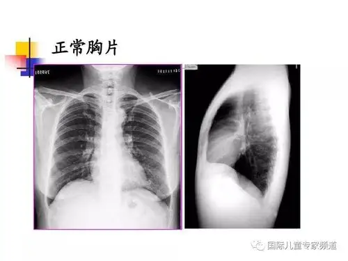 一张胸片能给我们提供多少信息