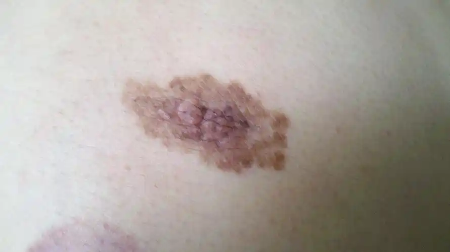 怎样区分黑色素瘤的良恶性?