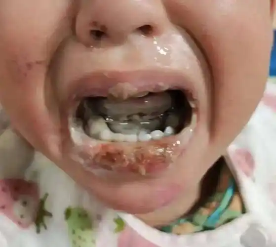 长沙一3岁幼童误食管道疏通剂,孩子满嘴发黑,口腔被严重灼伤!