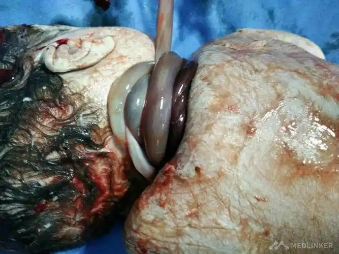 脐带绕颈周死胎1例