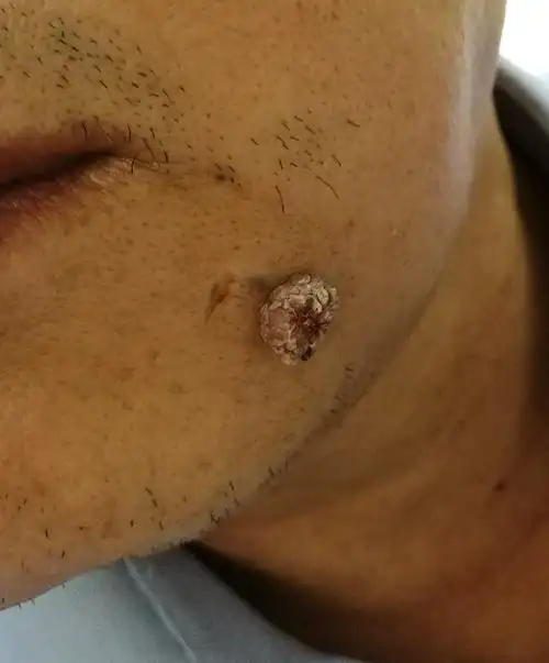 外阴脂肪肉瘤|这个皮肤问题原来是hpv感染引起的,如何避免呢?