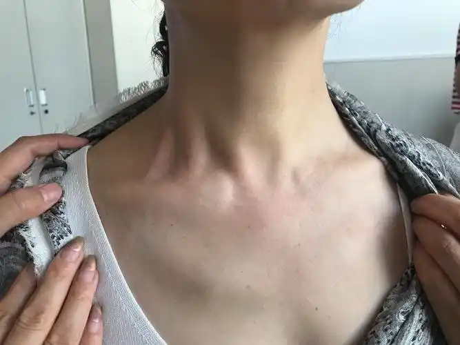 问诊精彩片段一: 这位女士舌头明显左斜,眼睛干涩,听力下降,右侧锁骨