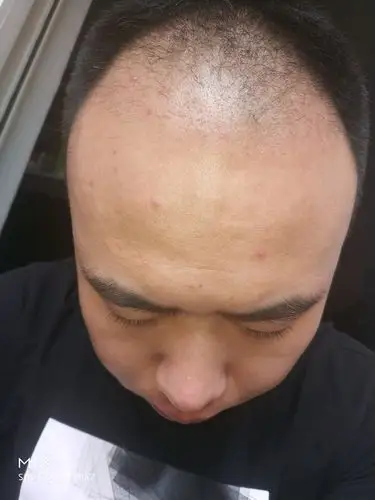 发际线种植2个月了,目前头发还没有明显的变化
