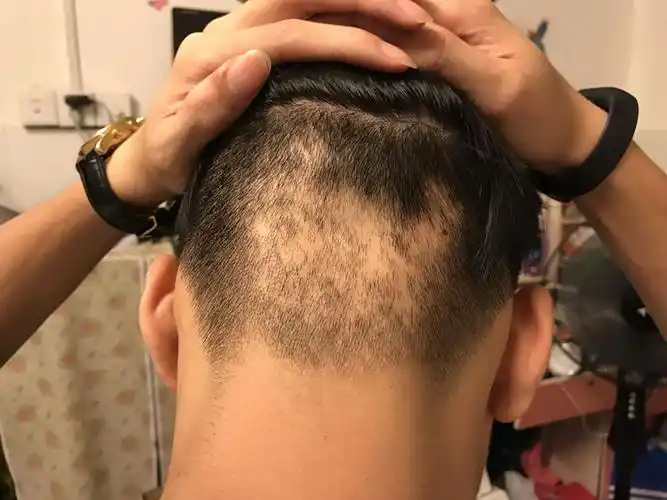 后脑勺局部脱发,一个月前脱了很少一块,后来越来越严重.