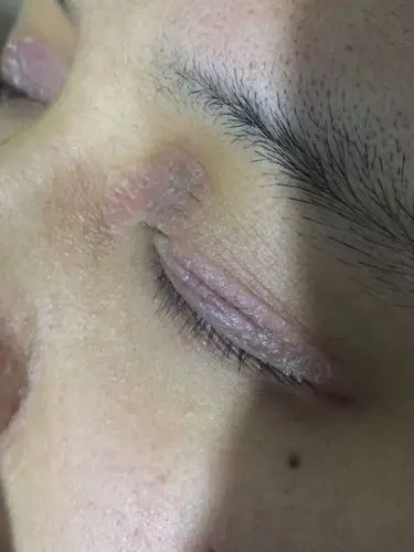 这眼皮是什么皮肤病请指点