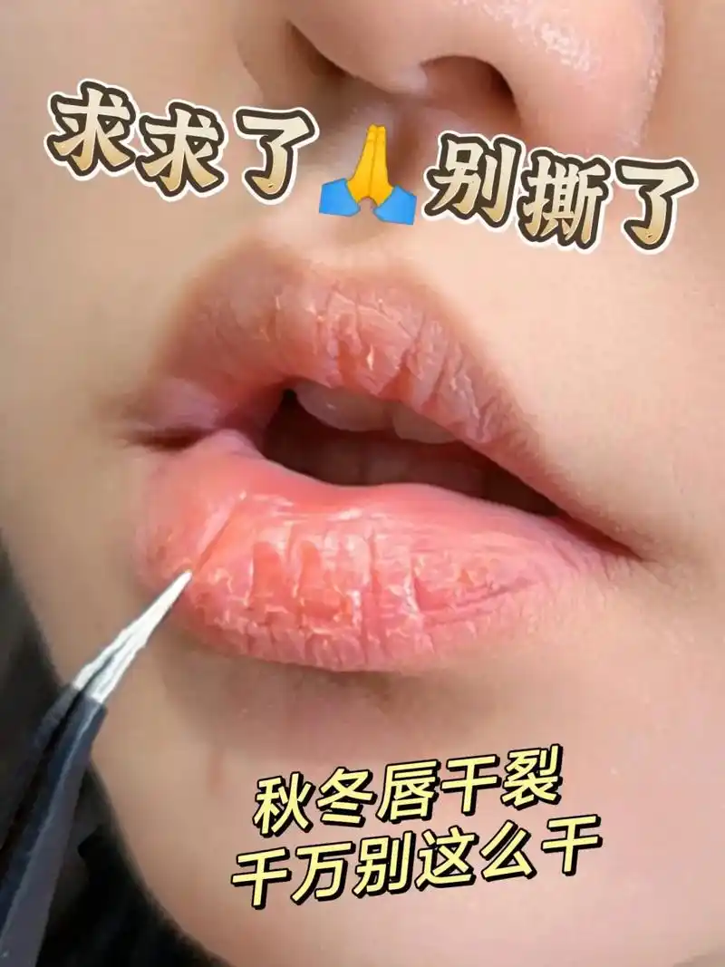 大数据把这篇推给唇裂的姐妹!秋冬嘴唇干,一笑就裂痛死了!速度 - 抖音