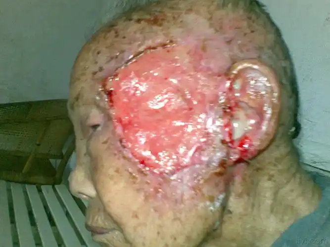 【病例讨论 2009-6】左面部皮肤癌合并蝇蛆感染