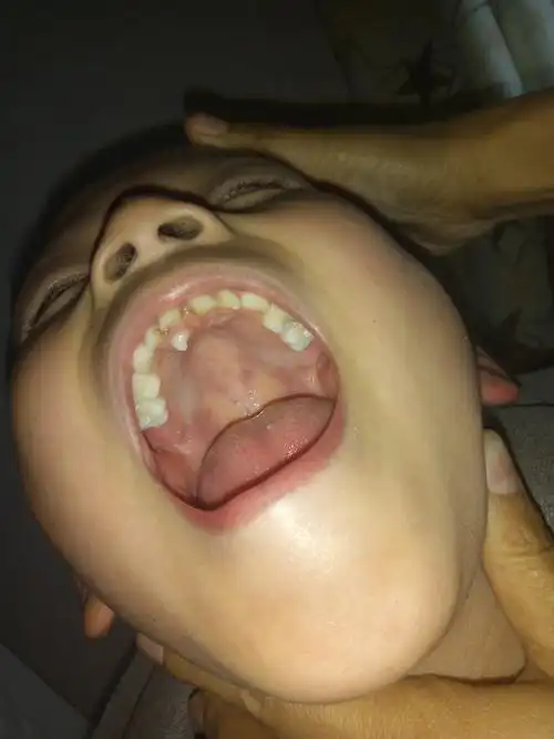 这颗牙形态是尖的,所以不是正常的牙齿,医学上称呼为 多生牙 ,需要