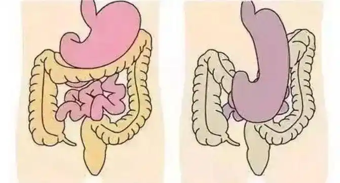 ④气候的变化也容易引起胃下垂.