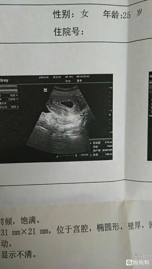 宽慰两个孕囊是龙凤胎的几率多大"一应俱全"-第1张图片-蒲城博客