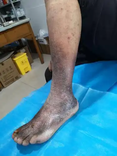 威县二十多年静脉曲张老烂腿四处投医未果,慕名就诊治疗效果对比