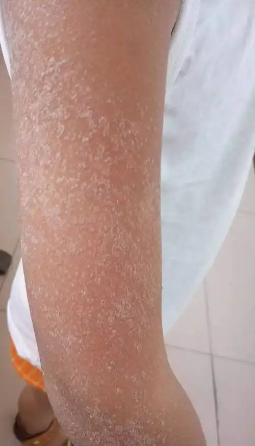 猩红热1例诊疗分析