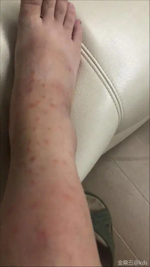 被跳蚤咬,太恐怖了