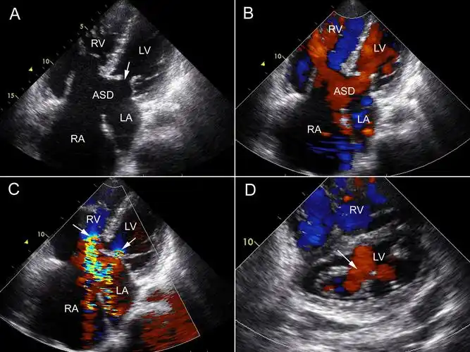 第7节 心内膜垫缺损 | 超声掌中宝