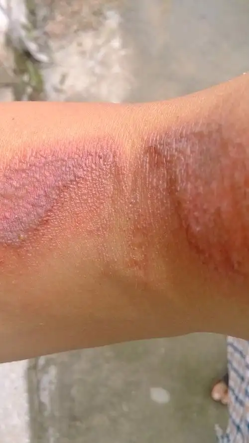 被不知名虫子咬了已有7天