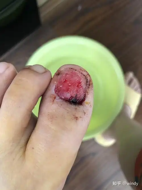 甲下血管球瘤20年