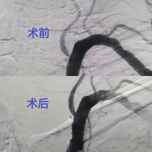 椎动脉支架一例分享