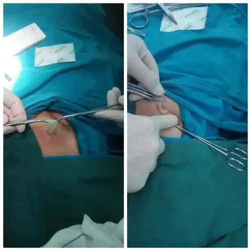 传统开腹疝囊高位结扎术