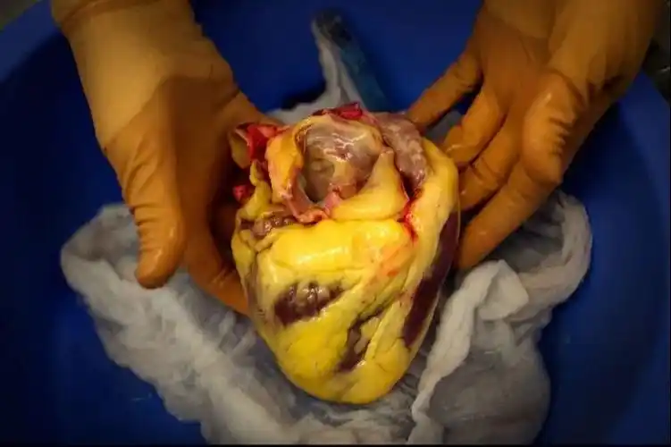 怎样减内脏脂肪这个你一定要知道