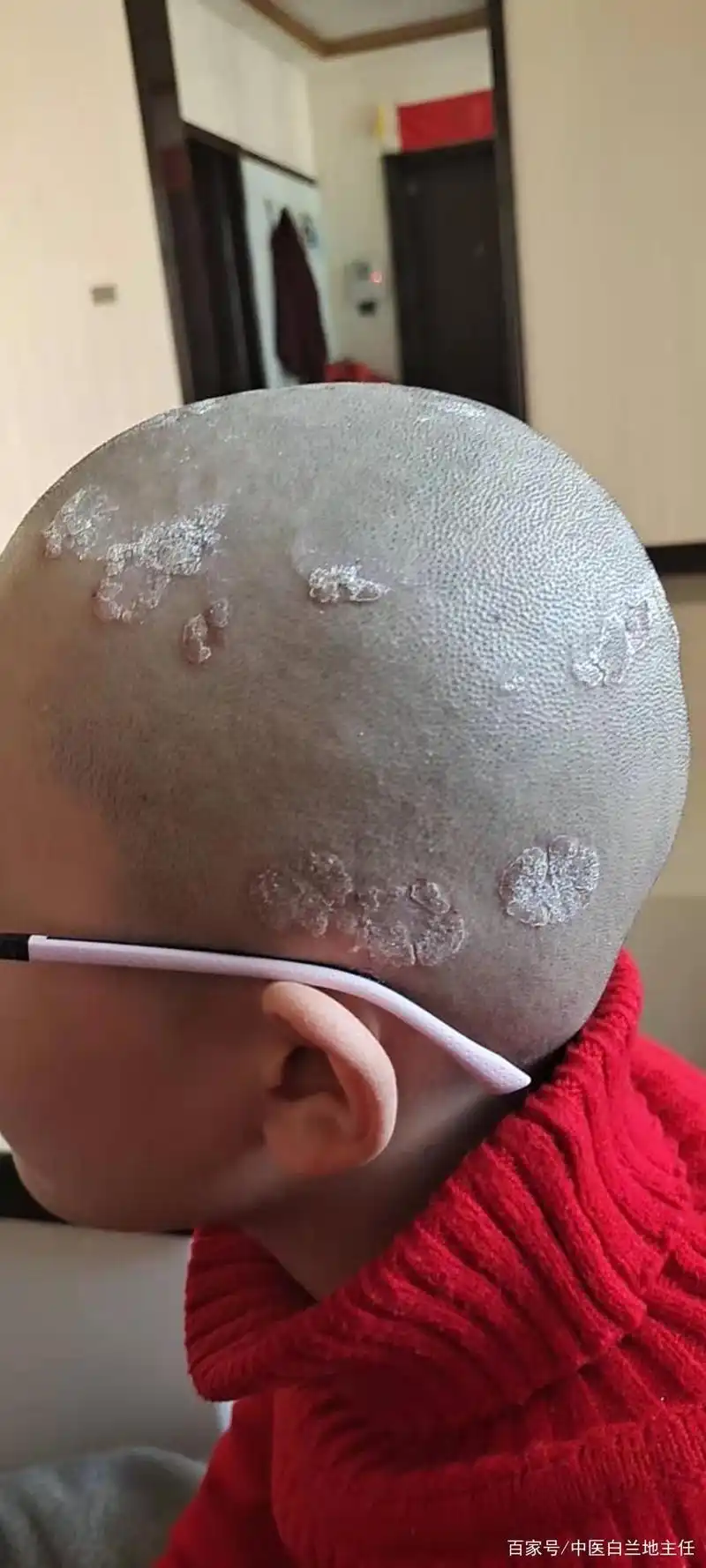 「病例分享」5岁小男孩头部银屑病终好转