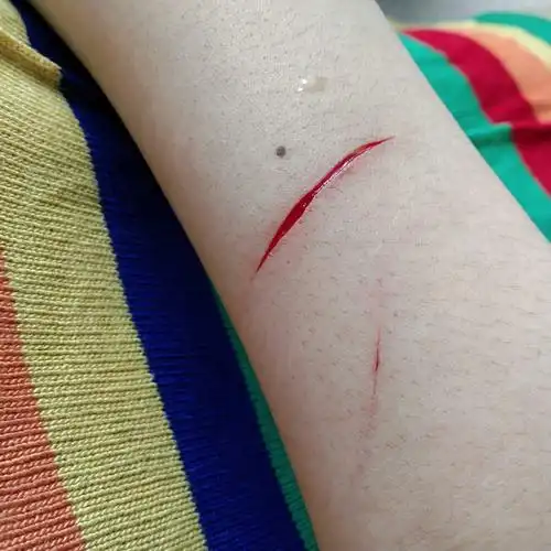 我情绪激动难过的 会自残会把自己胳膊抓的.